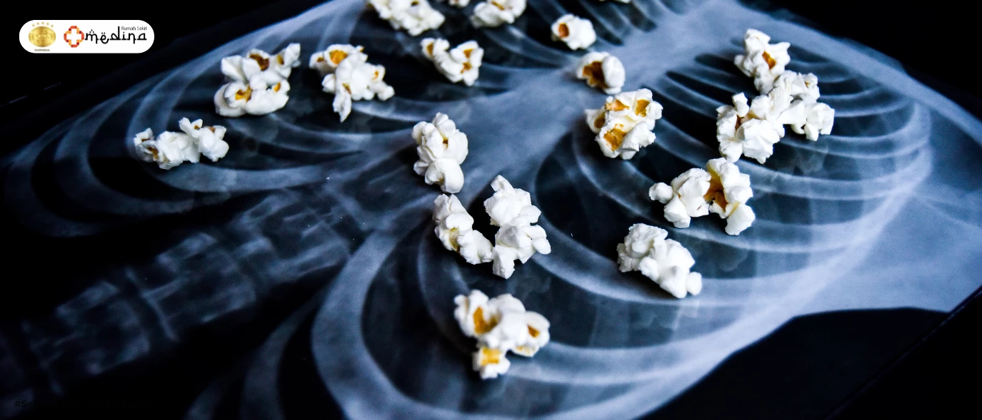 Popcorn Lung: Penyakit Berbahaya Akibat Kebiasaan Merokok