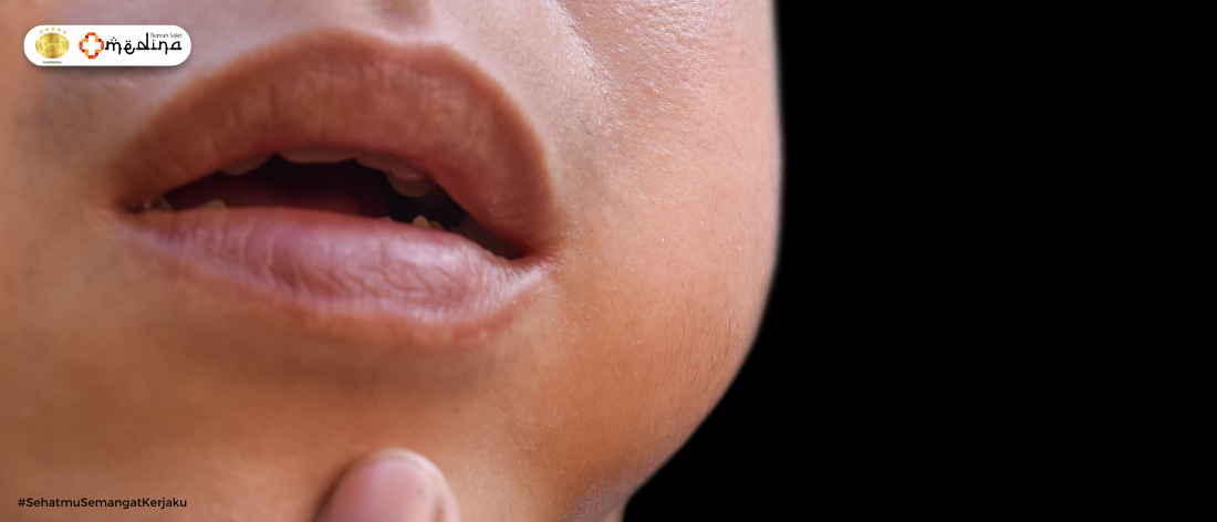 Waspada Parotitis: Penyakit Gondongan yang Sering Disepelekan!